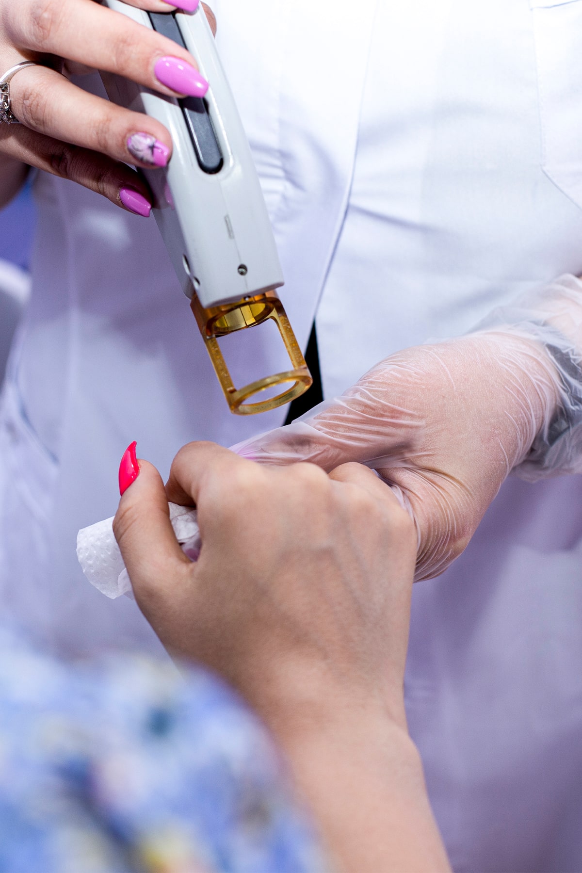 laser hair removal process