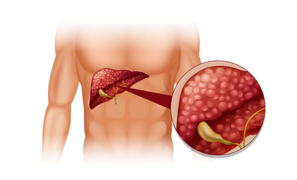 liver cirrhosis complete guide